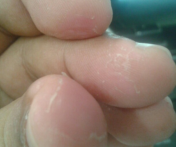 Quemaduras de alicina (quemaduras de&nbsp;ajo)