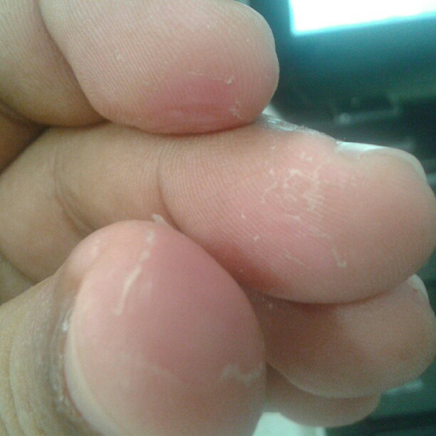 Quemaduras de alicina